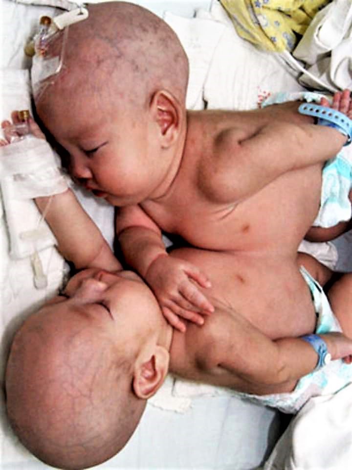 Death Hits Conjoined twins In Lofa County           …As Pres. Weah Expresses Concern